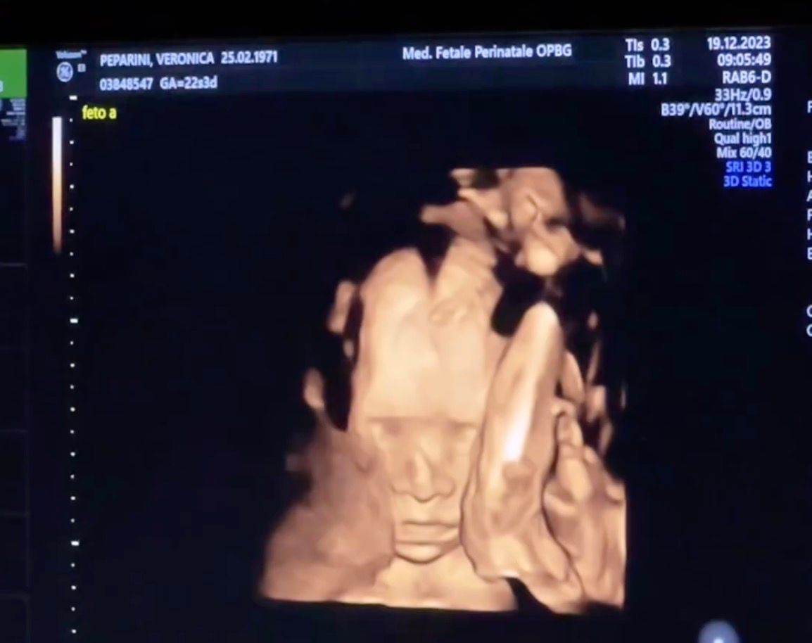 Andreas Muller e Veronica Peparini, l'ecografia delle gemelle