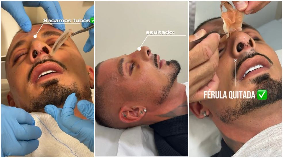 El exparticipante de 'LIDLT 10' ha enseñado el proceso al completo de su cirugía estética y el resultado