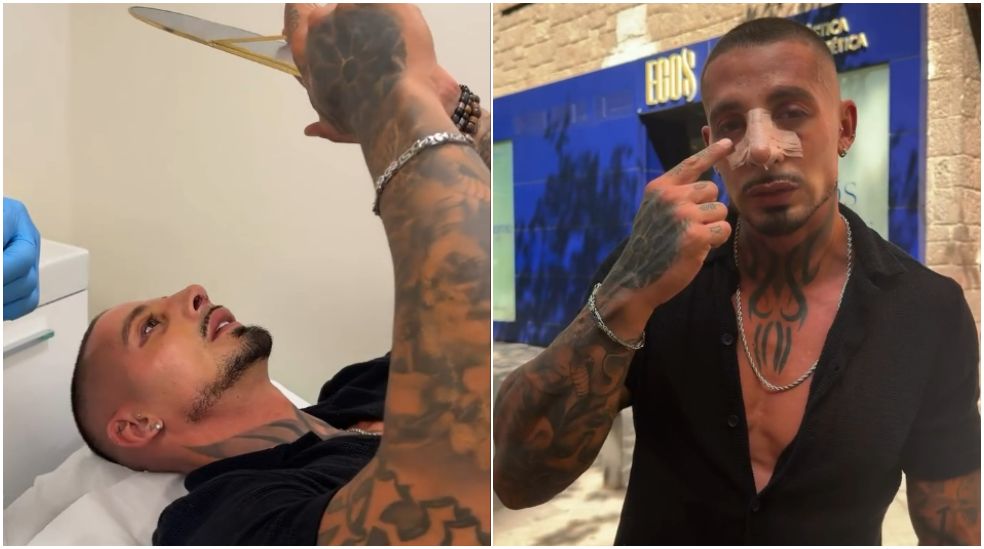 José, de 'LIDLT 10', se ve por primera vez en el espejo con su nueva nariz