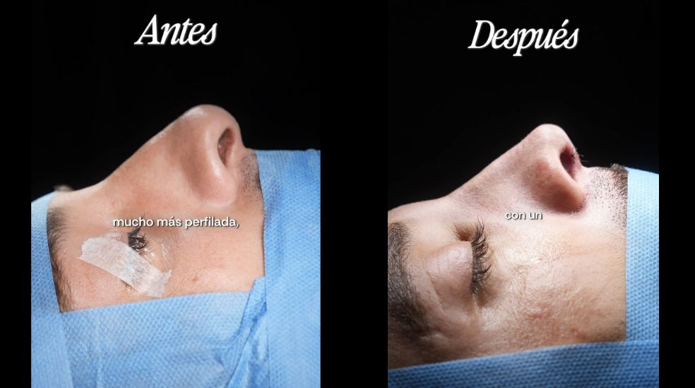 José, de 'LIDLT 10', se ha sometido a una rinoseptoplastia y muestra su resultado