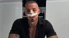 José, de 'LIDLT 10', enseña el resultado final de su rinoseptoplastia tras quitarse los tubos y puntos