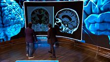 Así es un cerebro con Alzheimer visto desde dentro: lo que la enfermedad le hace a nuestra mente