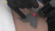 La realidad sobre la eliminación de los tatuajes con láser
