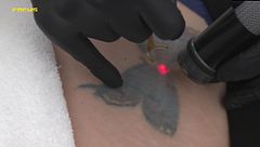 La realidad sobre la eliminación de los tatuajes con láser