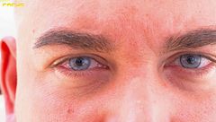 Cambiar el color de los ojos es posible con la queratopigmentación