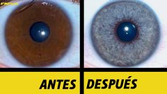 La despigmentación, la intervención en auge para cambiar el color de los ojos
