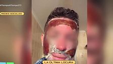 El tratamiento de costra antiarrugas, la última locura viral: “Puede acabar incluso en la muerte”