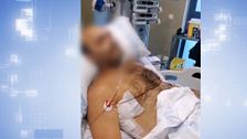 El presunto ladrón apuñalado por un hostelero rompe su silencio: "La primera puñalada que me dio han sido 36 grapas"