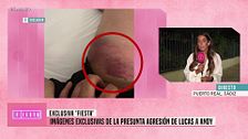 Andy muestra las heridas en su pierna tras su pelea con Lucas