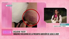 Andy muestra las heridas en su pierna tras su pelea con Lucas