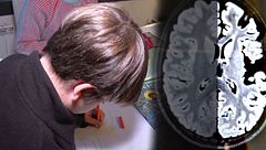 León, un niño de 9 años, vive con medio cerebro desconectado: "Se quedó como congelado mirándome"