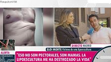 La pesadilla de Eloy tras una mala praxis en su lipoescultura: con dolor crónico y una "pelota de tenis" bajo el pectoral tres años después