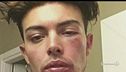 Difende una ragazza, picchiato