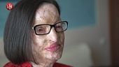 NINA: Sfregiata dall'acido, il coraggio di Filomena