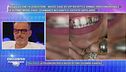 I gioielli dentali