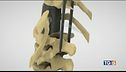 Trapianto di vertebre, Italia prima al mondo