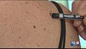 Il melanoma