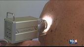 Melanoma, diagnosi e cure