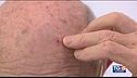Cheratosi, lesioni cutanee dovute all'esposizione al sole