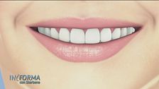 Lo sbiancamento dei denti