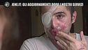 Aggiornamenti Iene.it: Giuseppe, sfregiato con l'acido: "Il Covid fa rimandare le operazioni"