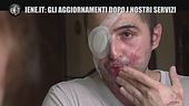 Aggiornamenti Iene.it: Giuseppe, sfregiato con l'acido: "Il Covid fa rimandare le operazioni"