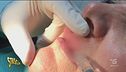 Filler per le labbra, occhio agli abusivi