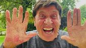 Morandi mostra la mano ustionata