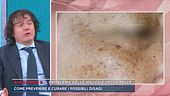 Prof. Santo Raffaele Mercuri, il problema delle macchie della pelle
