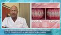 Un sorriso perfetto con le faccette dentali