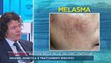 Macchie della pelle, melasmi, lentiggini