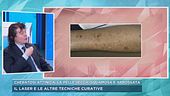 Il prof. Santo Raffaele Mercuri ci parla della cheratosi attinica e le tecniche curative