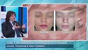Acne: cause, tecniche e trattamenti