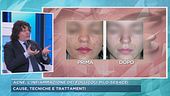 Acne: cause, tecniche e trattamenti