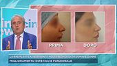 La rinoplastica, intervento molto richiesto