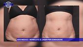 Mirella e il laser per dimagrire