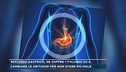 Reflusso gastrico, ne soffre 1 italiano su 4