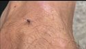 Febbre West Nile, cresce l'allerta