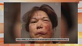 Parla Mirella, vittima di un intervento estetico andato male