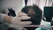 Capelli, dal trapianto a nuove terapie per combattere la calvizie