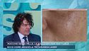 Macchie della pelle, le soluzioni per trattarle