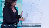 Liposcultura, nuove tecniche e casi consigliati