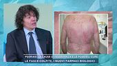 Psoriasi, le cause di insorgenza e le possibili cure