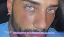Chirurgia estetica: tra gli influencer è occhi azzurri mania