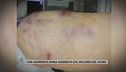 Cani aggressivi, Maria aggredita dal molosso del vicino