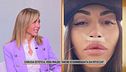 Chirurgia estetica, Vera Miales: "Anche io danneggiata dai ritocchi"