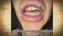 Chirurgia estetica, la storia di Veronica "Vittima del dottor silicone"