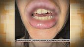 Chirurgia estetica, la storia di Veronica "Vittima del dottor silicone"