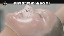 PECORARO: Operare i tumori senza toccarli