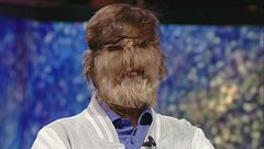 Lalit Patidar: l'uomo con più peli sul viso